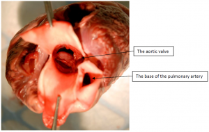 The aortic valve and base of the pulmonary artery.