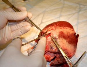 Cutting open the coronary artery.