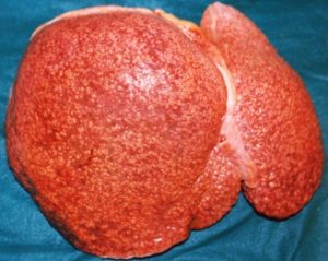 photograph of a liver with a mottled appearance