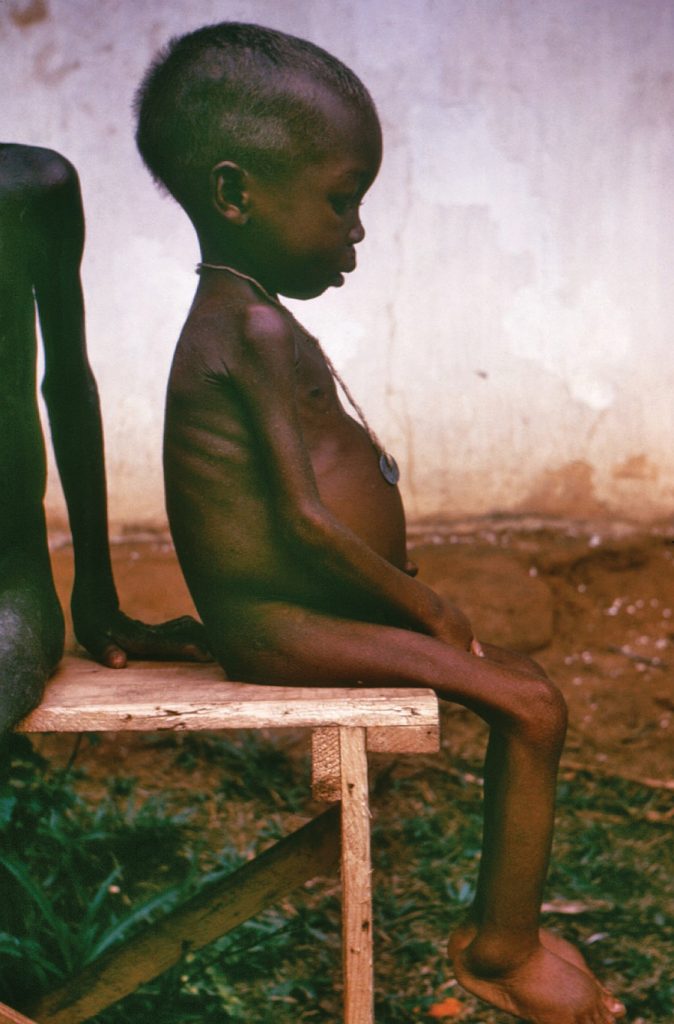 Malnourished child sufferring from protein deficiency.