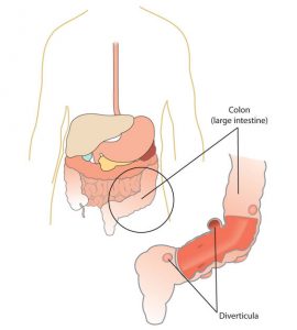 Illustration of body showing location of diverticula in the large intestine