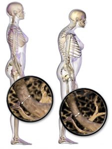 Illustration depicting normal standing posture and osteoporosis