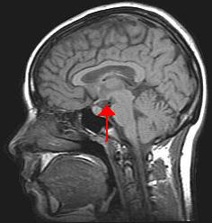 Sagittal View of the Brain with arrow pointing to hypothalamus
