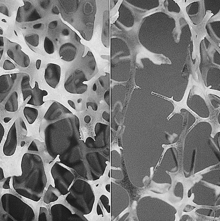 A micrograph shows normal (left) and degraded (right) trabecular (spongy) bone.