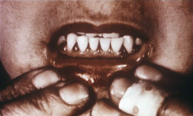 Bleeding gums in a patient's mouth